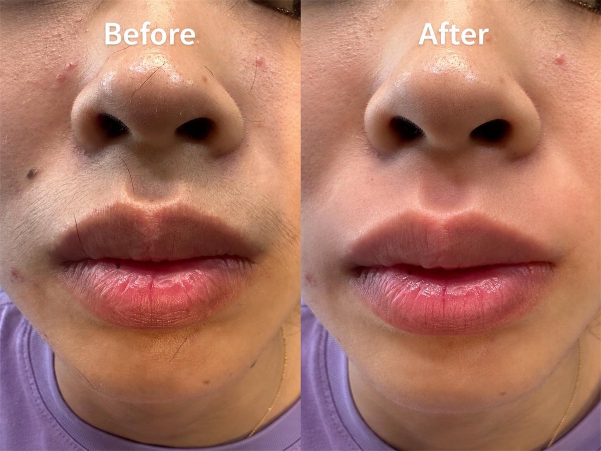 Upper lip and face threading — before and after